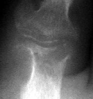 Gout: Large erosion with overhanging edges 1st metatarsal