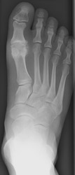 Osteoarthritis: AP View - Large osteophytes and joint space narrowing at 1st MTP joint