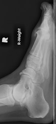 Osteoarthritis: Lateral View - Large dorsal osteophytes at 1st MTP joint